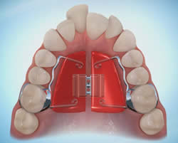 Orthodontic Appliances - Palatal Expander