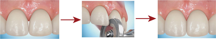 Orthodontic Appliances - Interproximal Reduction (IPR)